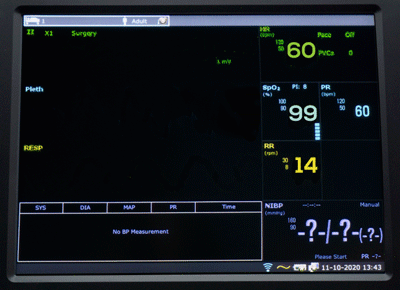 Edan 12 inch Wi-Fi enabled patient monitor in use