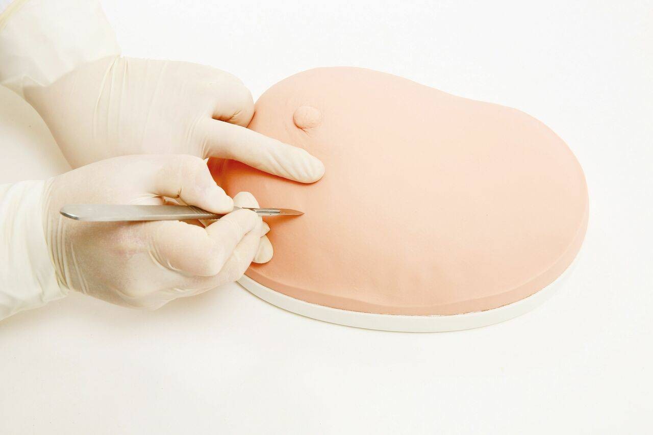 The Anatomy Lab-A-106742 Excision of Benign Tumor of Breast Simulator, 1/ea