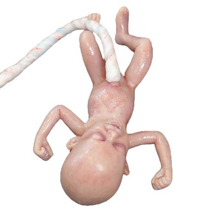Safeguard Medical 28-week Pre-term Advanced