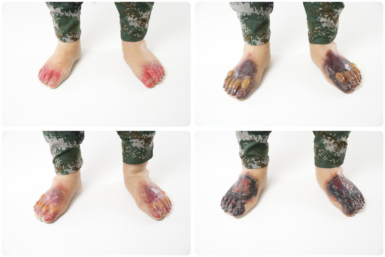 The Anatomy Lab-A-113004 Wearable Frostbite Injury Kit, 1/ea