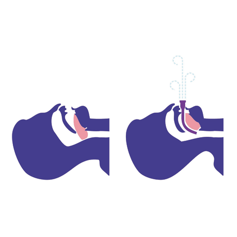 Sharn/Marketlab-106537 McMurray Enhanced Airway (MEA), 10/pk