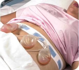 Bird & Cronin-0814 8220-Prody Drainage Bulb Holders - DBD-HOLDER, DRAINAGE BULB, PRODY 1/EA