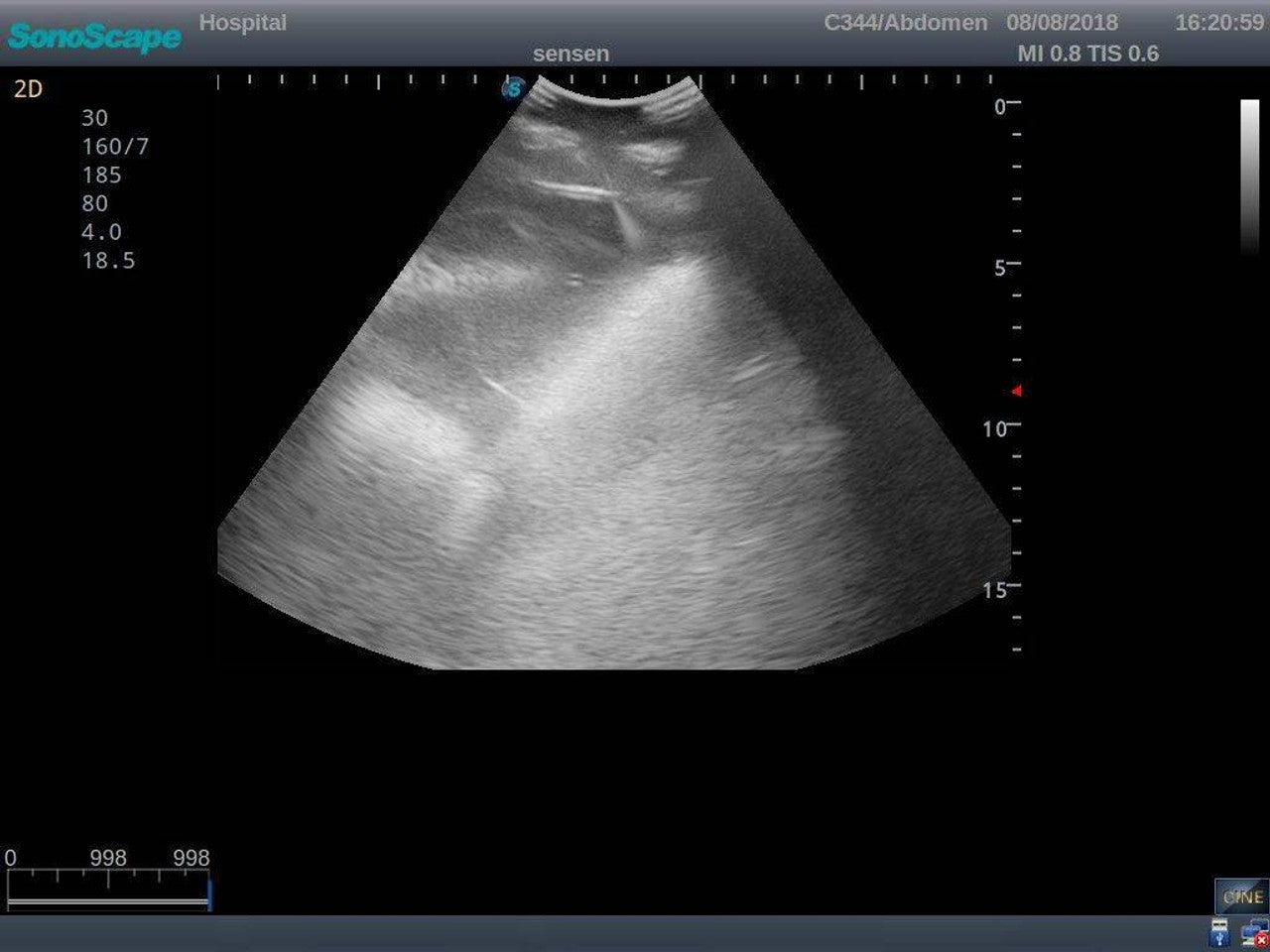 The Anatomy Lab-A-108518 Thoracentesis Ultrasound Training Model, 1/ea