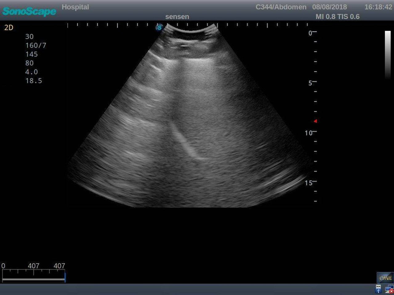 The Anatomy Lab-A-108518 Thoracentesis Ultrasound Training Model, 1/ea