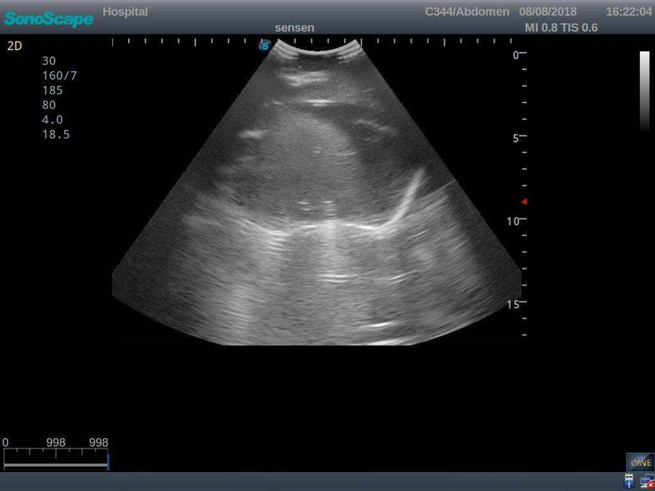 The Anatomy Lab-A-108518 Thoracentesis Ultrasound Training Model, 1/ea