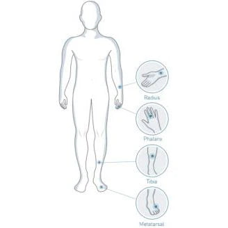 BeamMed Sunlight MiniOmni Ultrasound Bone Sonometer