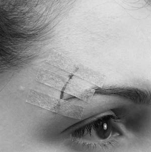 Aspen Surgical Sterion® Wound Closure